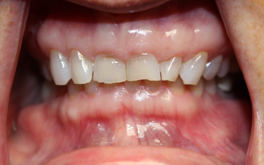 Porcelain crowns, Family and cosmetic dentistry