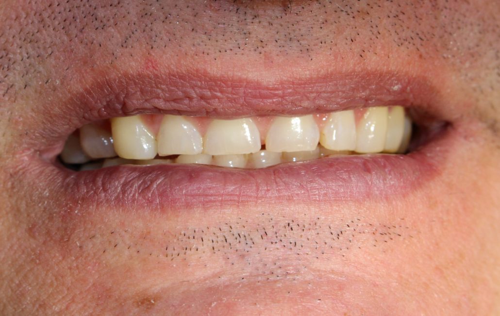 Porcelain crowns, Cosmetic dentistry