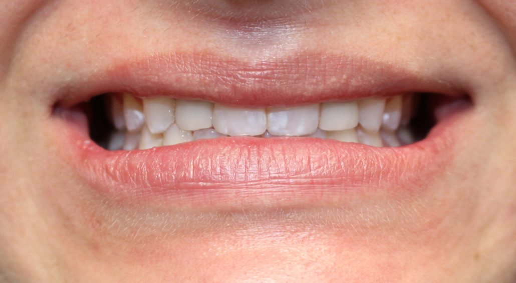 The best dental implants dentist, Dental implants
